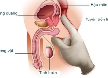 Tìm hiểu thông tin cần về ung thư tuyến tiền liệt